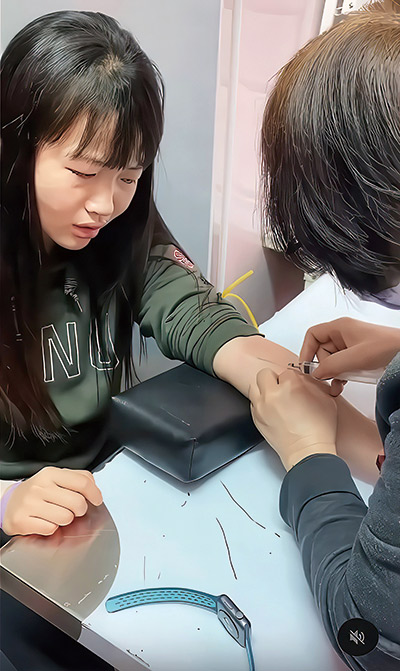 女足隊員在實驗期間，經常被非專業醫事人 員抽血，導致手臂出現大片瘀青。