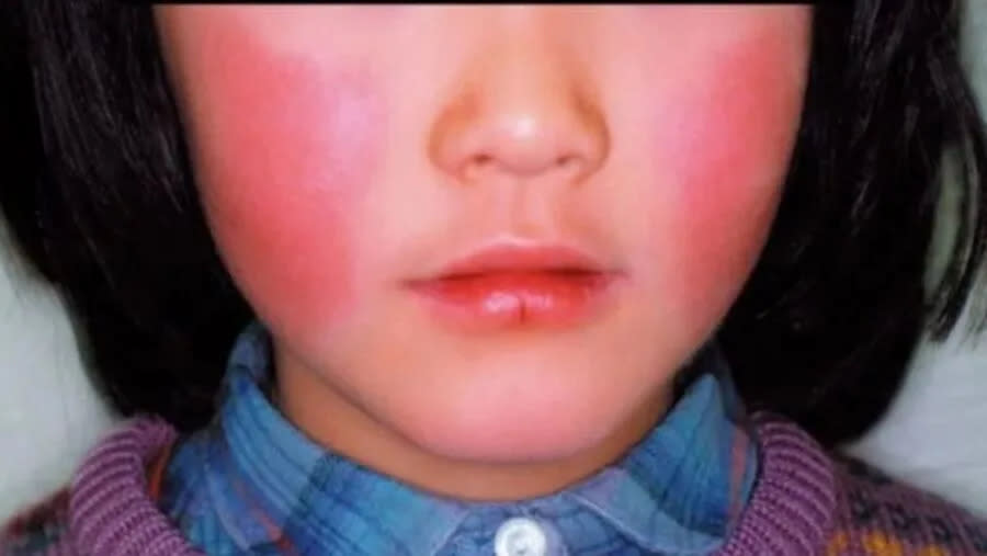 致命B19病毒是什麼？11歲女童大叫一聲猝死…蘋果病症狀像感冒，潛伏期、傳染途徑、高風險族群一次看