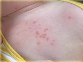 家長注意！幼童身上長「小珍珠」竟是病毒，傳染力強兄弟姊妹恐遭殃…醫：2類小孩感染風險高