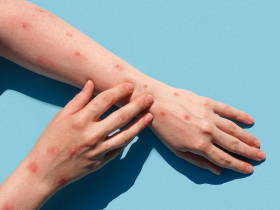 猴痘再爆15例，本土單周新高！增購2萬瓶疫苗下週可預約…猴痘症狀有哪些？疫苗怎麼打一次看