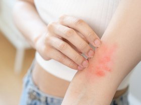 五成亞洲病患有狼瘡腎炎  泡泡尿、血尿是徵兆 「百變怪」紅斑性狼瘡  病因不明需共處