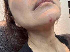 立院再掀女人的戰爭！林楚茵控遭王鴻薇暴打見血，一個秀驗傷單喊告、一個反駁：打人的喊救人