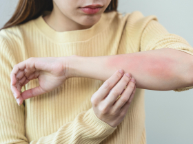 異位性皮膚炎有新藥，患者不再痛苦難耐！降低發炎與搔癢率達100%…醫：日常保養、擦乳液仍是關鍵