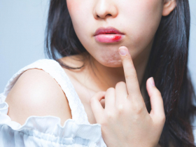 「嘴破」有什麼特效藥？西瓜霜、鹽巴、維他命…過來人推這水果：一次吃2顆就好了