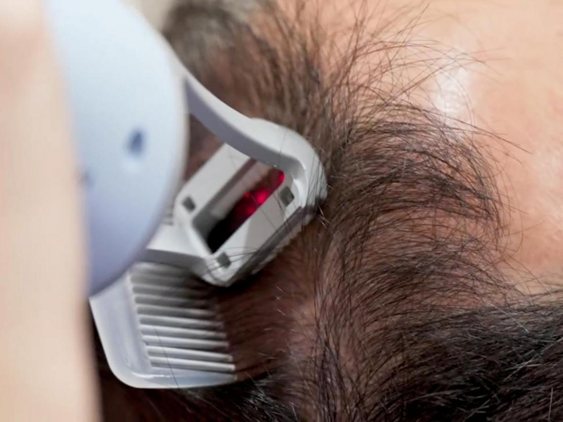 頭皮管理新世代｜拉髮密雷射科技落髮治療，愛爾麗率先導入