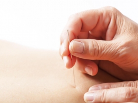 〈中醫夏季享瘦〉──找回完美腰線 埋線、服藥雙管齊下  告別小腹人生