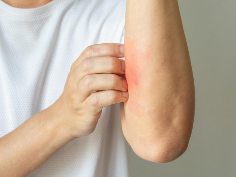 泡熱水＋酒精止癢，皮膚竟裂開變「蜂窩性組織炎」！每年500萬人乾癢就醫…醫曝3大NG習慣越洗越乾