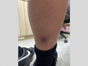 毒性休克症候群是什麼？12歲男童發燒無力不是流感、褲管拉開醫急喊快送急診：一拖延致命機率急速拉高