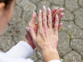 長年濕疹治不好竟癌末，29歲女生：我不該等癌細胞擴散全身才被發現…T細胞淋巴瘤是什麼、症狀有哪些