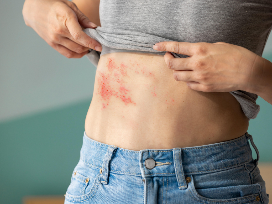 老人才會得皮蛇？病毒侵襲30歲男害「聽損、臉歪」…醫揭驚人數據：這3部位最易發病「尤其右側」