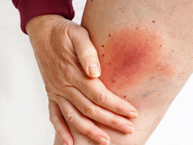 萊姆病是什麼？初期像感冒還會皮膚紅癢…台灣首例境外移入，嚴重恐心律不整、腦膜炎…傳染途徑、預防方式