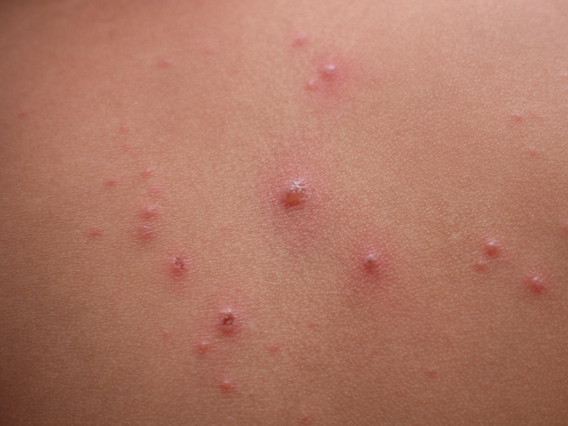 水痘感染力有多強？為何南港高中8人確診還不停課？衛生局回應了…水痘症狀、好發期、感染族群一次看