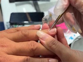 指甲異狀別輕忽！他易喘「指甲1變化」揪出肺癌，6大異常是警訊…權威醫：沒症狀靠LDCT篩檢才能發現