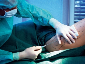 手術不當意外 接二連三 術前術後要把關 抽脂塑身可遠離風險