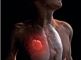 找出關鍵基因  掌握肺癌治療黃金期