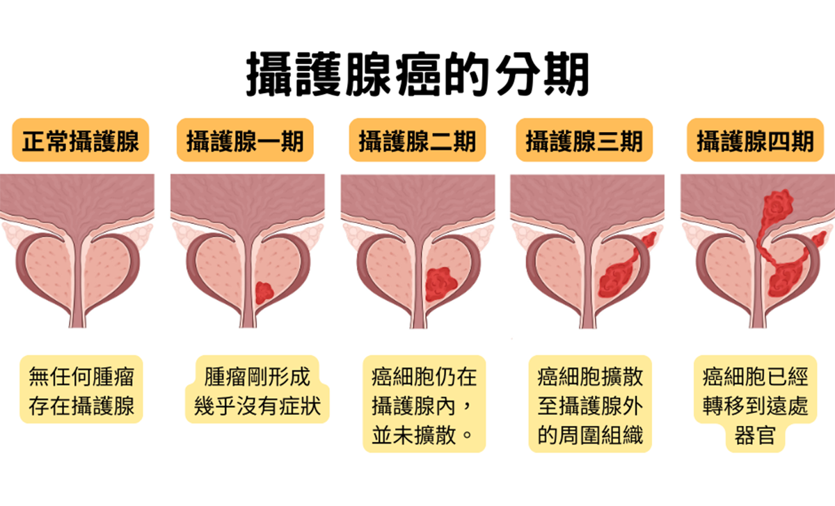 攝護腺癌分幾期如何治療