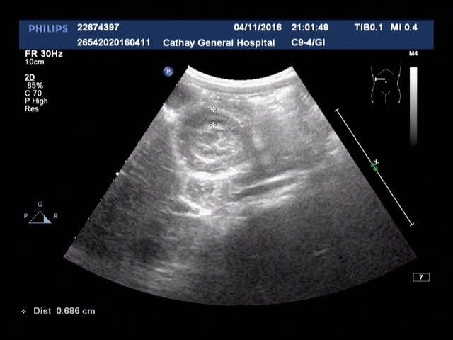 類過敏性紫斑症與腹痛