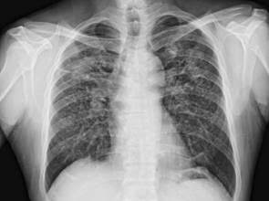 塵肺症與PM2.5無關？ 醫師來解惑