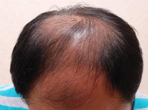 落髮知多少？頭髮健康一測就知道