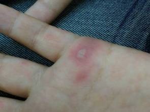 腸病毒冬天橫行　大人也遭殃