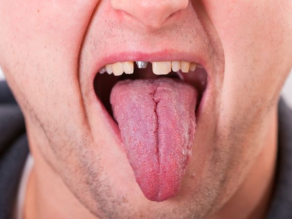 當「墓碑牙」出現　你離缺牙不遠了！