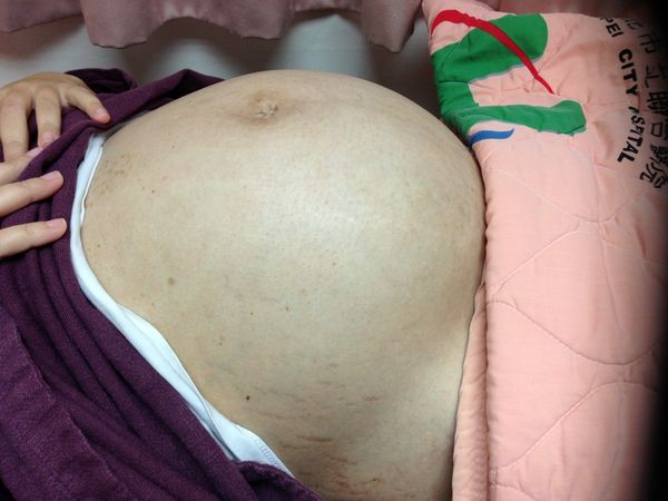婦子宮肌瘤重達6千克　有如懷雙胞胎