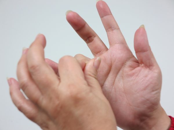 拉傷手指　可透過熱敷或電療舒緩