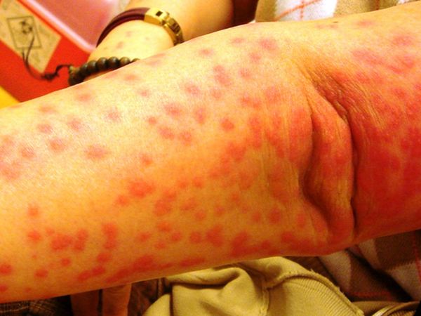 女子全身冒紅疹　毛毛蟲皮膚炎惹禍