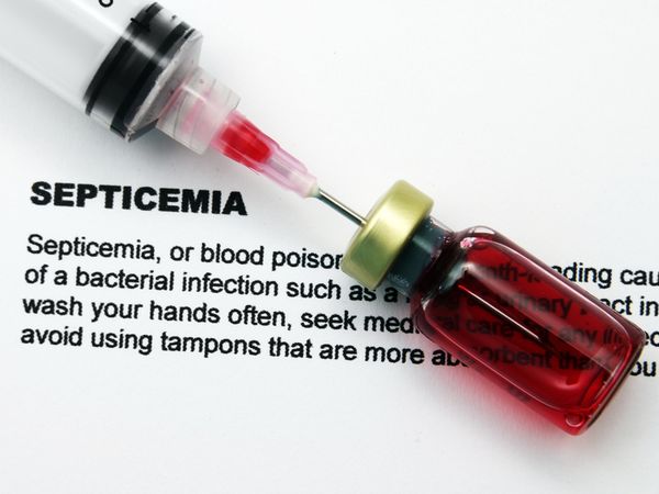 臺灣發現敗血症新藥重要關鍵！