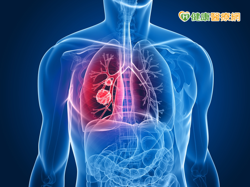 揪出肺癌循序漸進　可用哪些武器？