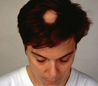 中醫養生防掉髮