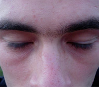 手術矯正 眼瞼下垂bye！bye！