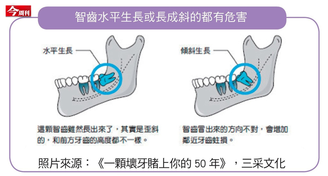 牙醫師謝懷德揭開壞牙暗藏身體危機
