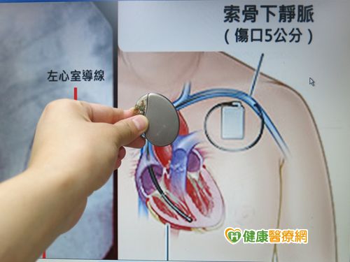 心衰竭險亡 雙心室同步強心節律器救命