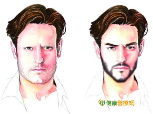 植鬍求速效討歡心 醫：恐弄巧成拙