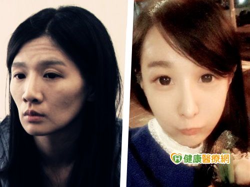 苦命臉變貴婦 削骨達人自體脂肪移植豐額建功