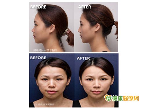 打造完美鼻型！醫師技術是成敗關鍵