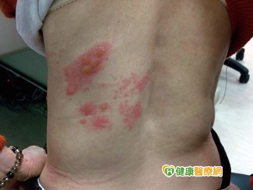 病後皮膚奇癢無比 竟長帶狀皰疹