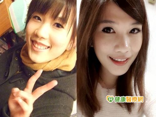 牙齦也吹整形風！？「露齦笑」bye-bye！