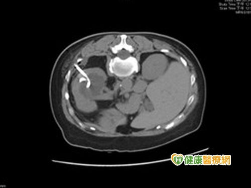 泌尿道結石莫輕忽　病況嚴重恐致死
