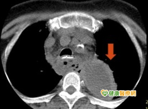 罕見原發性縱隔腔膿瘍　糖尿病患易好發