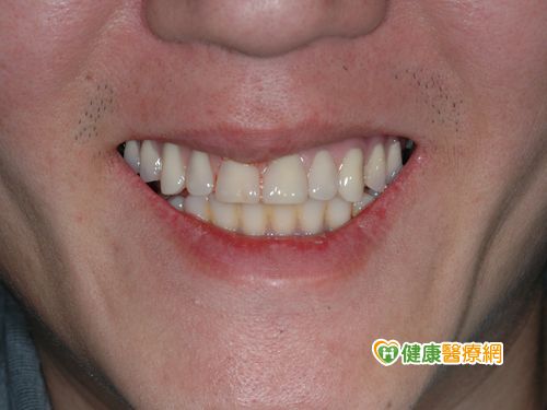 All-on-4植牙 讓阿嬤與金孫一同長牙！