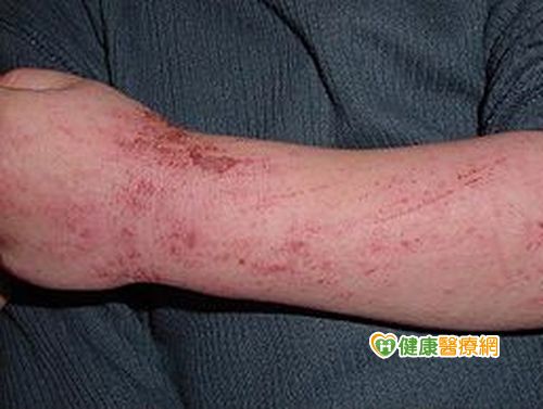 步步驚心！ 疾病有可能經由皮膚進入