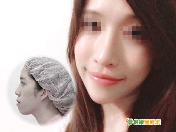 削骨手術免正顎！　讓戽斗女煥然一新