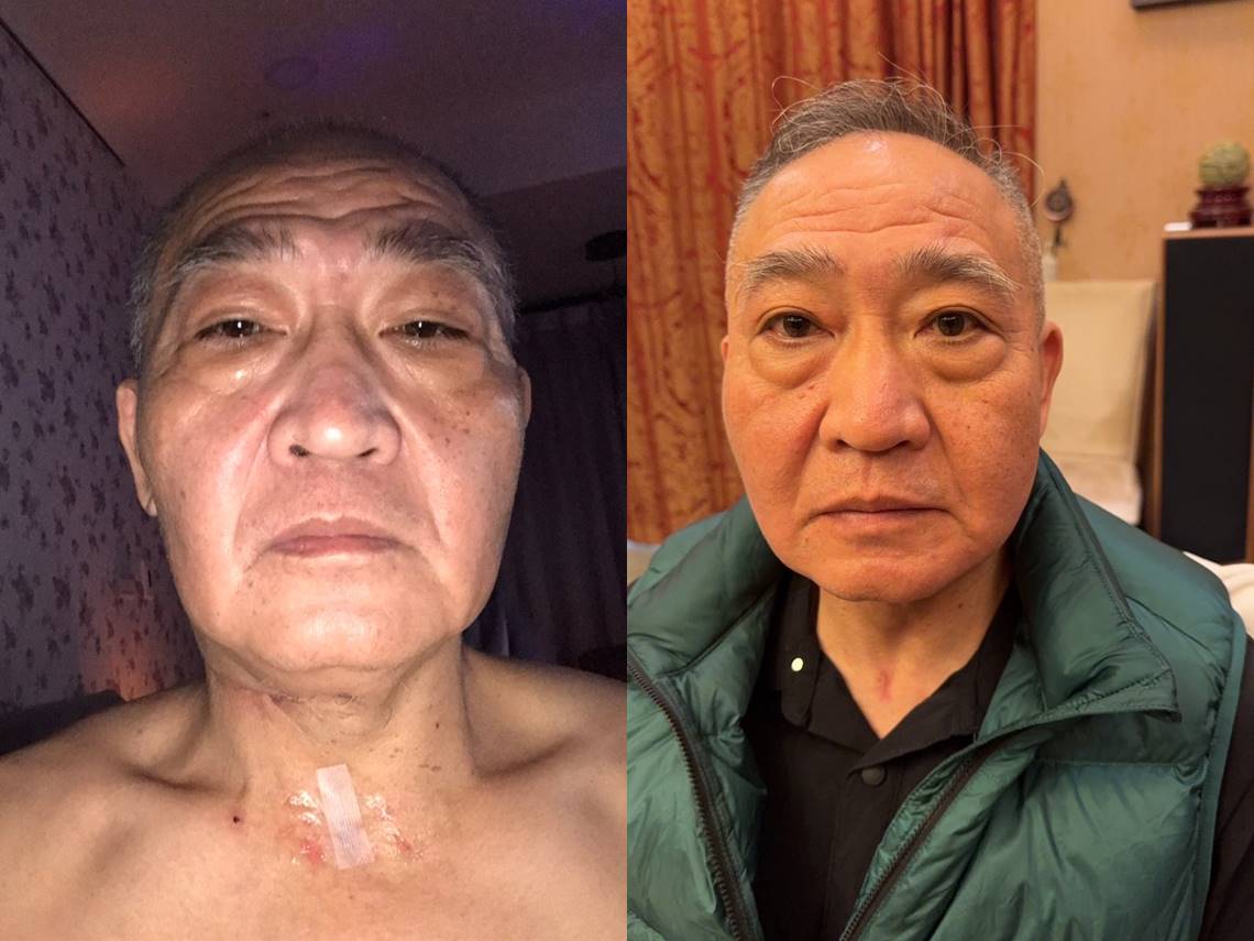 讓手術後的紀錄，整個人看起來蒼老很多，但我招信，逆不是災厄，而是老天爺的提醒，要我更關照自己。